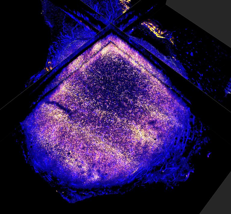 Targeting scar-forming gene could improve Radiotherapy outcomes for breast cancer patients