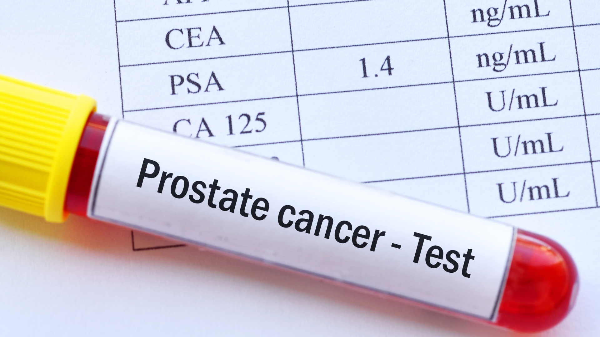 Prostate Cancer Screening: Why Malaysia Needs Local Evidence and Local Action 