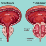Prostate Cancer Part 10 – Understanding The Various Eras And Progress In Prostate Cancer Management 
