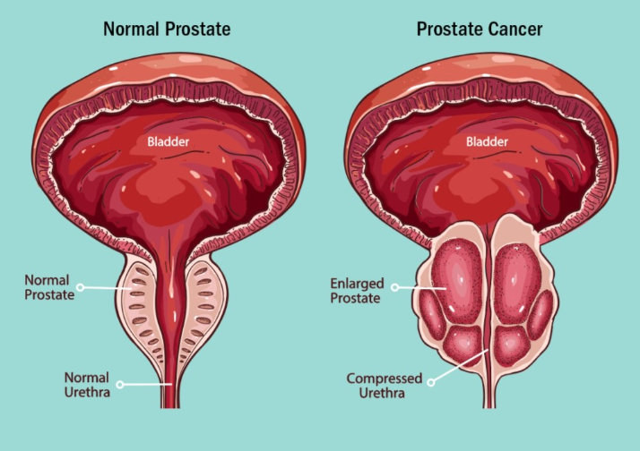 Prostate Cancer Part 10 – Understanding The Various Eras And Progress In Prostate Cancer Management 